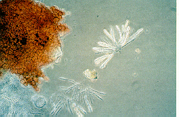 Figure 9. Cinnamon-orange perithecium representing the perfect fruiting stage of F. solani with ascospores contained in many sac-like asci.